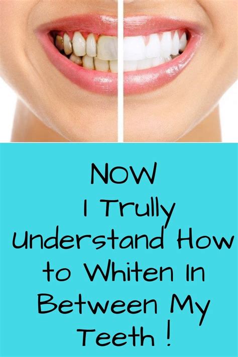 Pin on Teeth Whitening Tips For Nov & Dec 2018