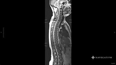 Cervical Thoracic Spine MRi by Navegatium App #Radiology #MRi Thoracic, Mri, Radiology, Cervical