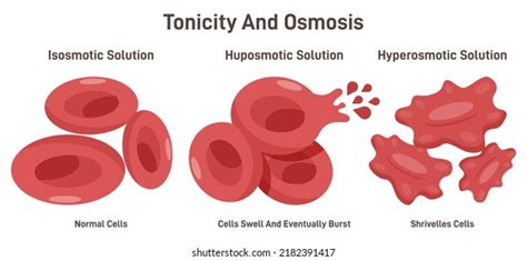 Hypertonic disease : 93 images, photos et images vectorielles de stock | Shutterstock