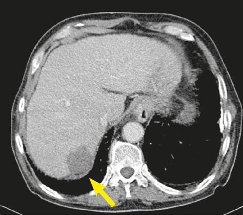 Right Lobe Liver Lesion