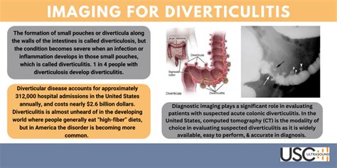 Imaging for Diverticulitis | Ultrasound Solutions Corp.