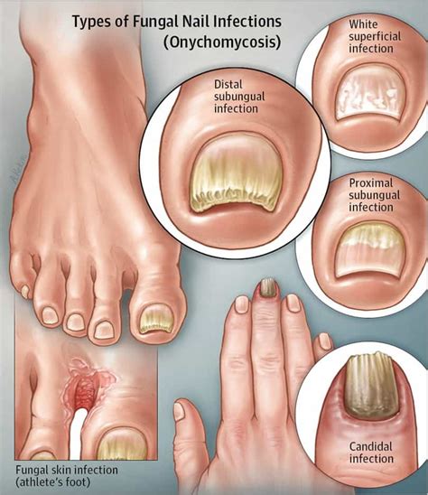 White Superficial Onychomycosis: Types, Symptoms, Causes & Treatment