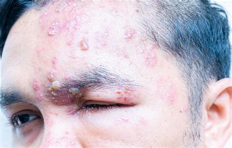 Shingles Treatment In NYC, Herpes Zoster, Shingles Rash, 49% OFF