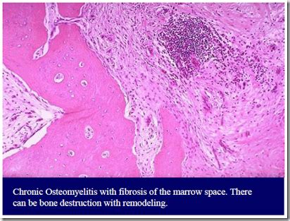 Osteomyelitis & Bone Tumours