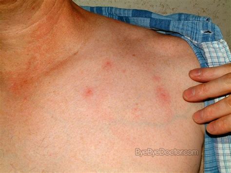 Chigger Bite – Pictures, Symptoms and Treatment