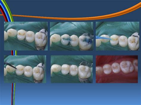 Composite Resin 101 — Emergency Dental Care Chicago