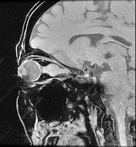 Optic Nerve Meningioma Mri