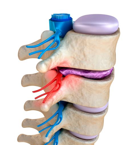 Pinched Nerve Symptoms and Treatments - Minnesota Spine Institute