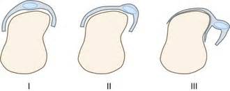 Sagittal Band Rupture Splint