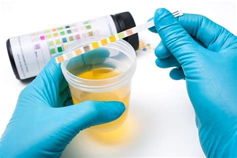 Urinalysis - What Does An Urinalysis Test For, How to Interpret Results