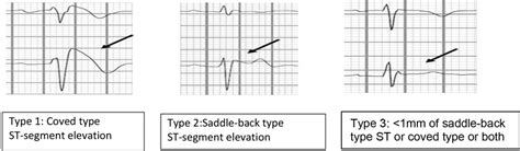 Three types of Brugada ECG pattern. ECG, electrocardiogram. | Download Scientific Diagram