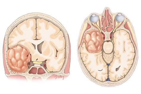 Olfactory Groove Meningioma | Case Study - Dr Sambuddha Dhar - Dr ...