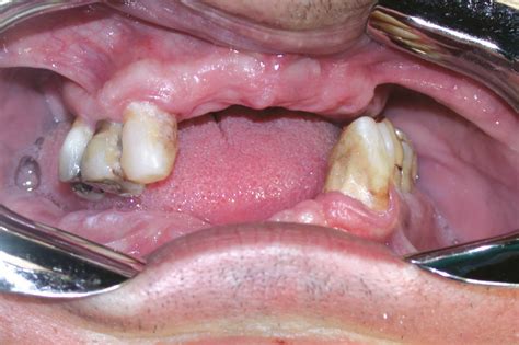 Implant treatment of a patient with edentulous jaws: a 12-year follow ...