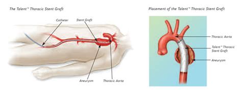 Endovascular Stent Repair of Thoracic Aortic Aneurysms