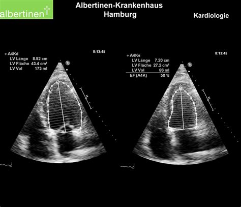 Ejektionsfraktion (Echo) - DocCheck