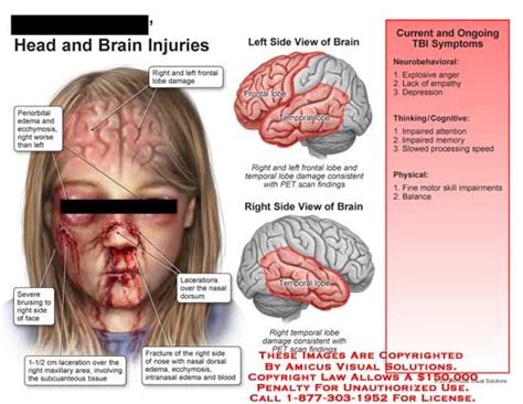 Frontal Lobe Brain Injury. | Brain injury, Brain injury awareness, Frontal lobe