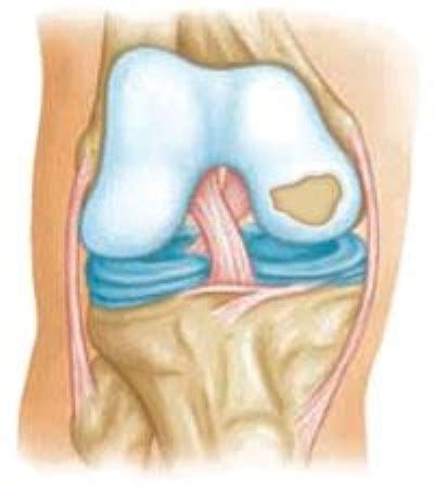 Cartilage Defects - Dr. Mukhi’s Raj Hospital