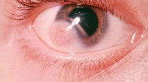 Cyst on Eyeball, Inside, behind, Causes, Pictures, Dermoid, Small Clear Cyst, Conjunctival, NHS ...