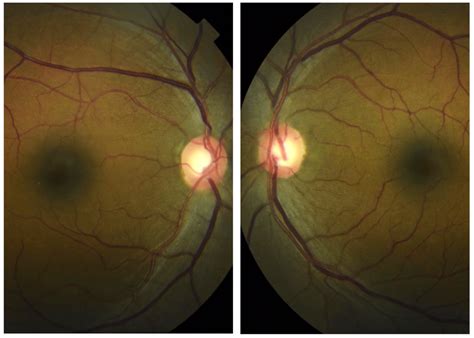 The Practical Approach to the Glaucoma Suspect