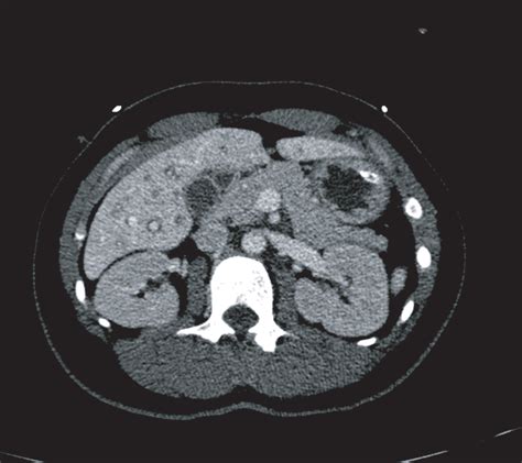 Pancreatitis On Ct Scan