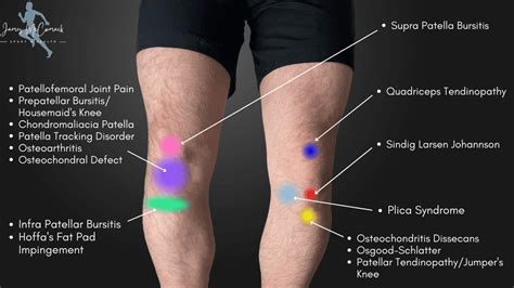 Knee Pain Location Chart Learn The Pain Location Of Knee Injuries | sexiezpix Web Porn