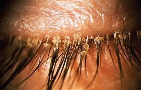 Dr Vision World | Demodex Infestation of the Eyelashes