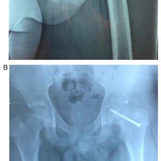 Diagnostic signs of SCFE shown on the AP (A) and FL (B) pelvis view of ...