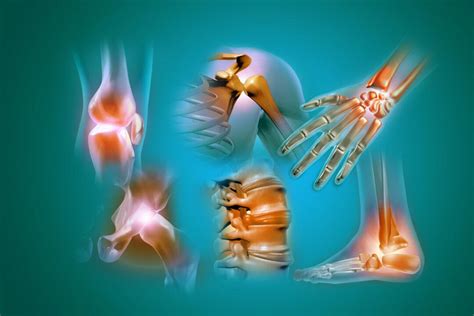 psoriatic arthritis | The Epoch Times