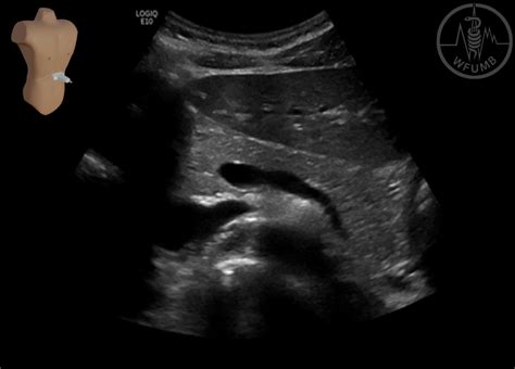 Splenic Vein Ultrasound