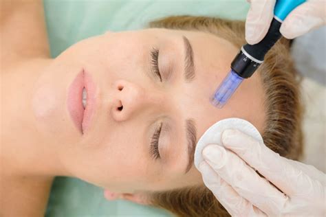 5 Surprising Microneedling Benefits for Your Skin