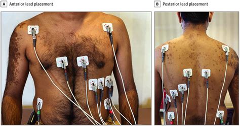 Influence of Prone Positioning on Electrocardiogram in a Patient With COVID-19 | Cardiology ...