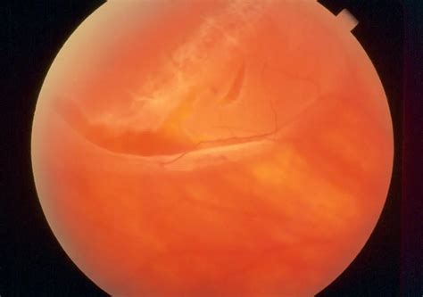 Retinal detachment - American Academy of Ophthalmology