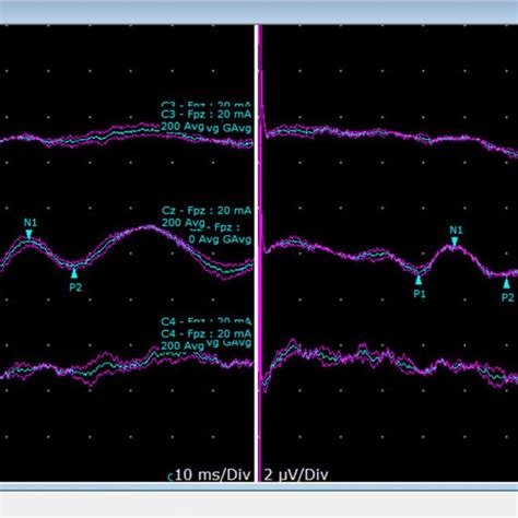 Bulbocavernosus reflex study. The response is recorded from the... | Download Scientific Diagram