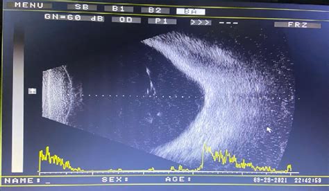 B-mode ultrasound of left eye | Download Scientific Diagram