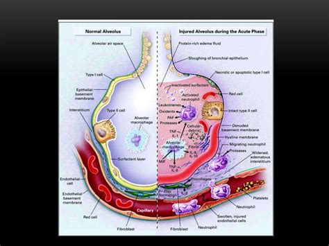 Shunt Pulmonar