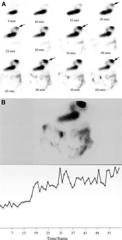 Gastric-Emptying Scintigraphy of Type III Hiatal Hernia: A Case Report