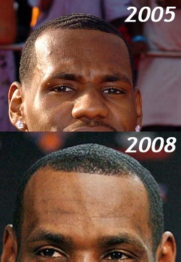 Lebron James Hair - Hair Transplant Analysis by Matt Dominance