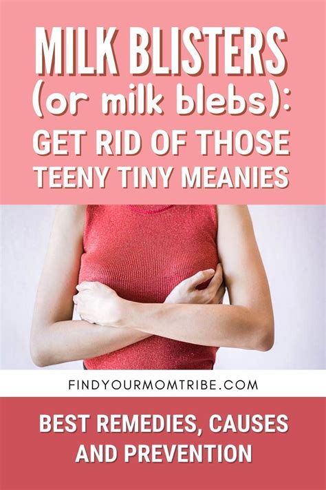 Milk blister 11 best remedies plus causes and prevention – Artofit