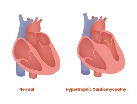 Hypertrophic Obstructive Cardiomyopathy & The Treatments