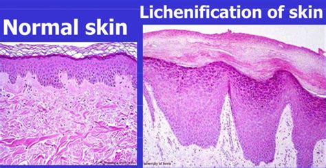 Lichenification of skin causes and how to get rid of lichenification