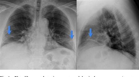 Figure 2 from Basilar Atelectasis as the True Predictor of Acute Abdomino-Pelvic Pathology -- A ...