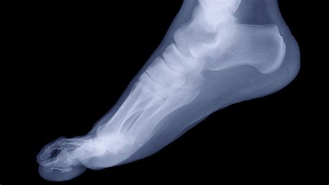 Experimental Therapy For Sore Heels Has Skeptics : NPR