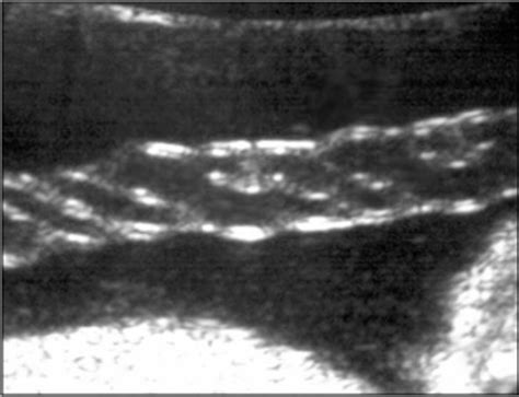 Assessment of Umbilical Cord Coiling During the Routine Fetal Sonographic Anatomic Survey in the ...