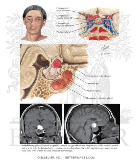 Pituitary Apoplexy