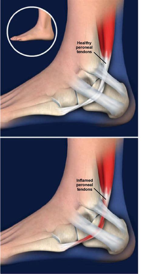 Peroneal Tendonitis Causes Symptoms And Treatment Options | Hot Sex Picture