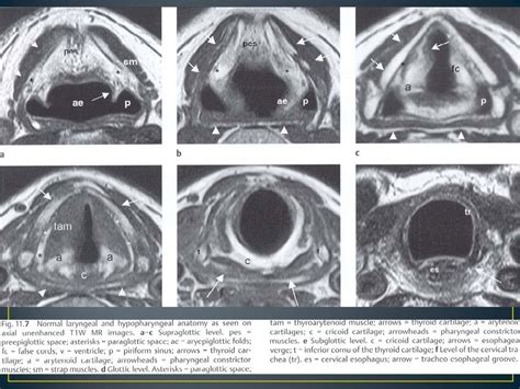 Larynx anatomy ct and mri