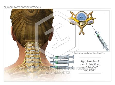Image 09830_im02: Cervical Facet Block Injections Illustration – Trial ...