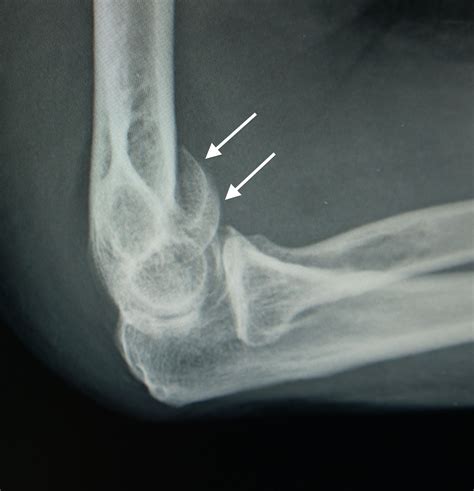 Treatment of Distal Humerus Fractures - Cancer Therapy Advisor