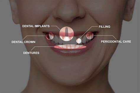 Full Mouth Reconstruction Recovery - Boston, MA