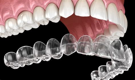 When was Invisalign Invented? | Invisible Braces